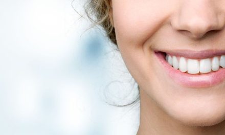 Aligner Transparan Jadi pilihan Untuk Merapikan Gigi Tanpa Kawat