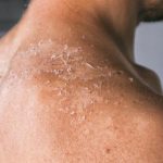Badan Berjamur: Penyebab Dan Cara Menjaga Kebersihan Kulit
