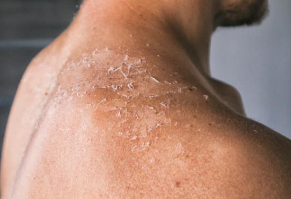 Badan Berjamur: Penyebab Dan Cara Menjaga Kebersihan Kulit